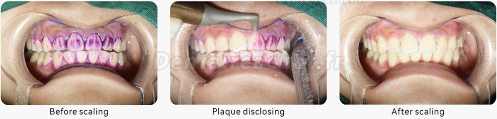 Woodpecker AP-A aéropolisseur dentaire (pièce à main sous-gingivale + supragingivale)